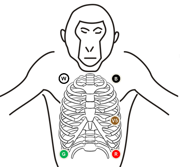Gallery For > Ecg 5 Lead Placement