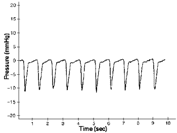 pleuralchronicpressure