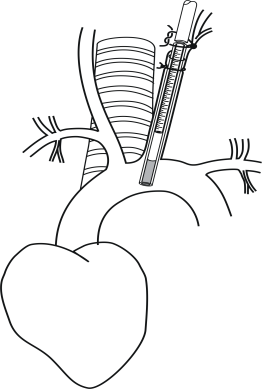 Optimal catheter placement in aortic arch