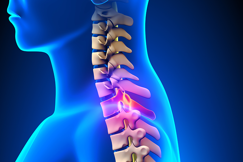 Spinal Cord Injury, SCI