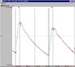 software module, blood pressure module, ecg software, blood pressure analysis