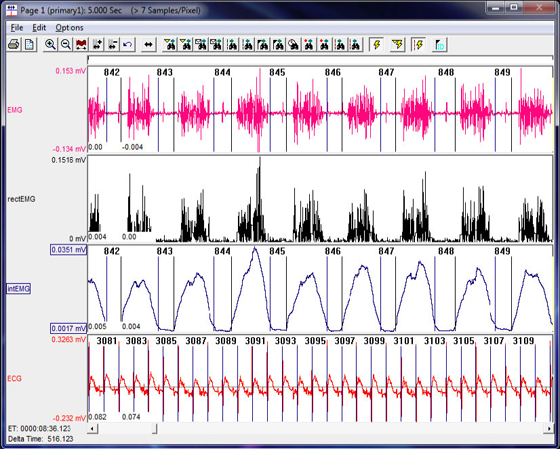 software module, ecg software, blood pressure analysis, dEMG, emg