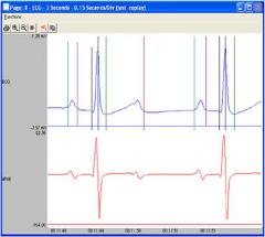 ecg software, software module, blood pressure analysis