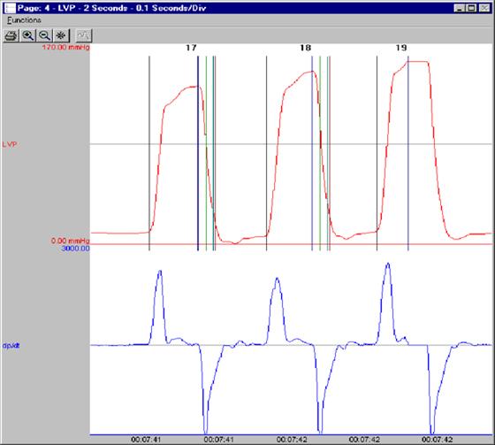 left ventricular pressure software