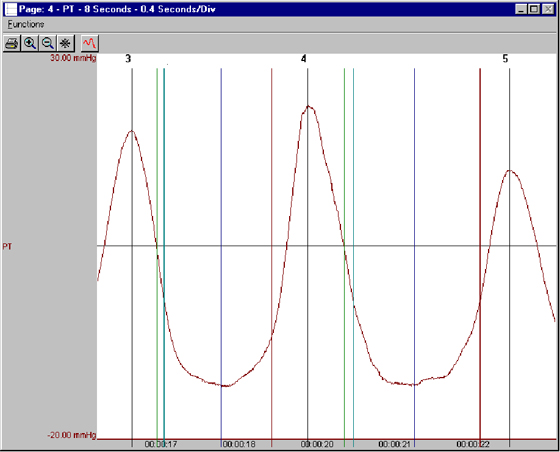 software module, ecg software, blood pressure analysis