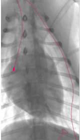 Solid Tip Lead x-ray